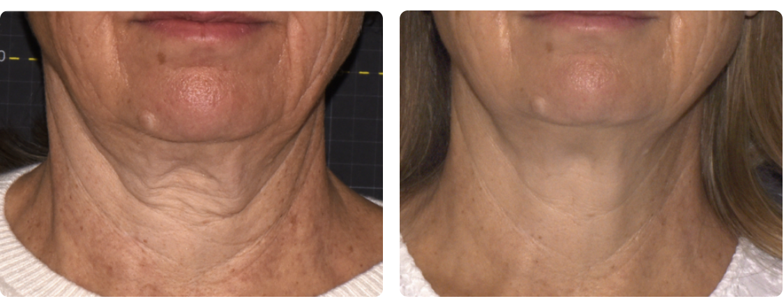 Ultherapy® is a revolutionary, FDA-approved, non-invasive skin tightening procedure offered at Skinspire Laser & Skin Clinic. This treatment helps lift and tighten the face and neck with the use of focused ultrasound technology.